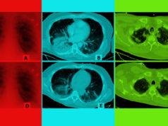 AI Alibaba dapat mendeteksi virus corona dalam hitungan detik