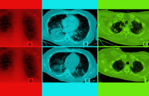 Alibaba Bisa Mendeteksi Virus Corona dalam Hitungan Detik, Akurasi 96% AI Alibaba dapat mendeteksi virus corona dalam hitungan detik