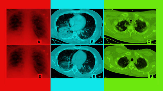 AI Alibaba dapat mendeteksi virus corona dalam hitungan detik